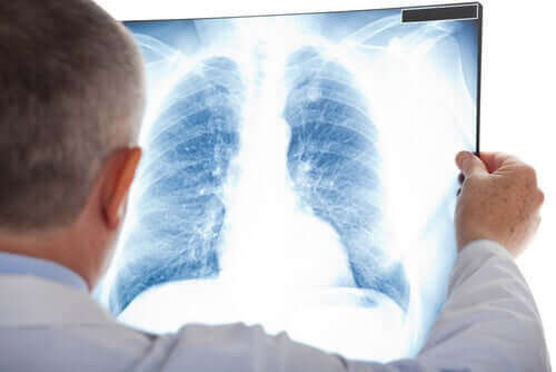 Keuhkopussintulehdus voidaan havaita röntgenillä.
