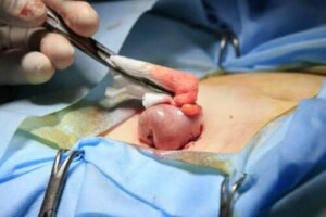 Mikä on kolostomia?