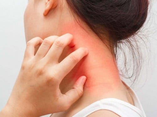 Atooppinen dermatiitti aiheuttaa punoitusta iholla.