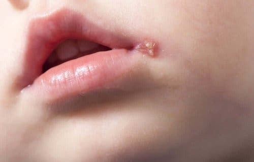 Yskänrokon oireet ovat yleisimmin rakkulat ja kihelmöinti huulessa
