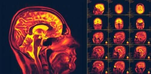 Mitä aivojen neuroplastisuus tarkoittaa?