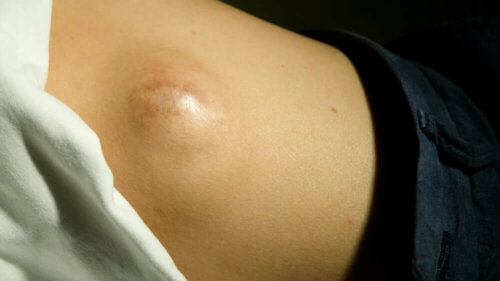 Rasvapatti tai lipooma on yleinen vaiva selässä, vaikka sitä voi esiintyä myös yläraajoissa ja kaulassa