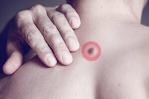 Mistä selän rasvapatit johtuvat?