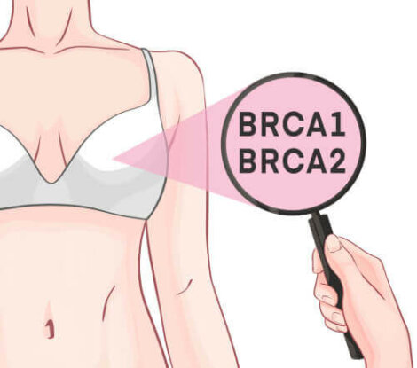 BRCA1- ja BRCA2-geenit ja rintasyöpä