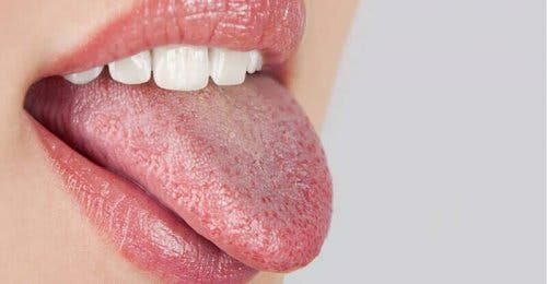 Suun polttelu voi johtua taustalla olevasta sairaudesta