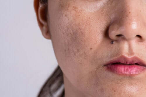 Mistä ihon hyperpigmentaatio johtuu?