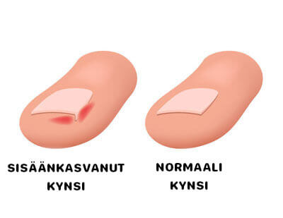 Kuinka leikata kynnet, jotta ne eivät kasva sisäänpäin.