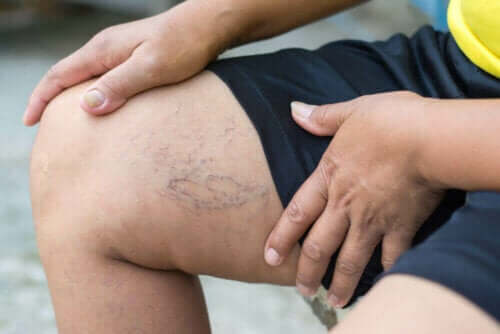 On olemassa joitakin liikuntamuotoja, jotka soveltuvat hyvin suonikohjujen hoitoon