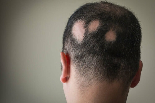 Alopecia areata eli pälvikalju on hyvin vähän tunnettu patologia