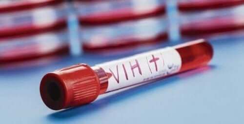 HIV-positiivinen verinäyte.