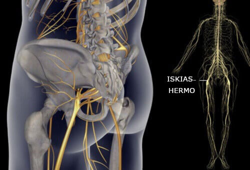 Helppoja liikkeitä iskiaskivun parantamiseksi