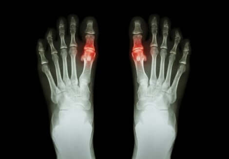 Kihti vaikuttaa yleensä erityisesti miesten jalkoihin