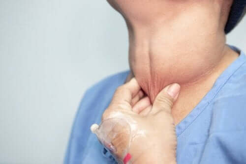 Kivuton kyhmy kaulalla on kilpirauhasen syövän oire