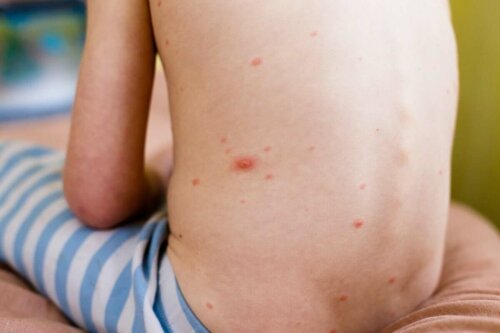 Lasten nokkosihottumassa ihon turvotus alkaa normaalisti vain muutaman tunnin kuluttua allergiaa aiheuttaneelle aineelle altistumisesta
