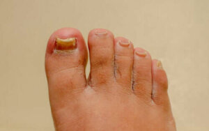 Kuinka tehokkaita kynsisienihoidot todella ovat?