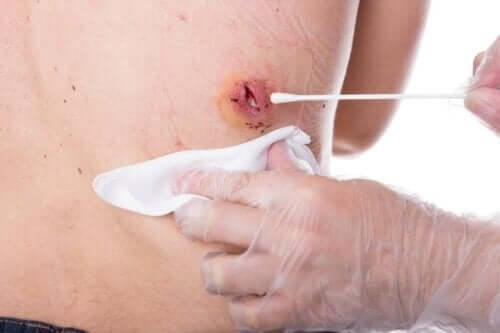 Epidermaalikystat voidaan avata ja tyhjentää