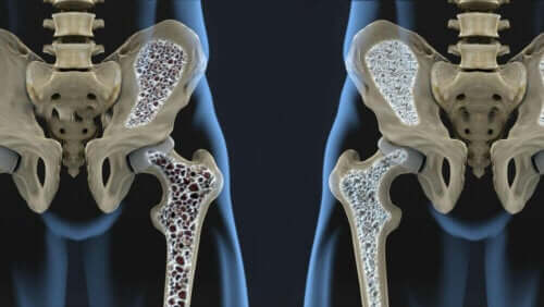 Osteoporoosin riskitekijät: luuston pieni koko.