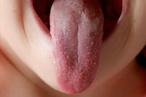 Tarttuuko tulirokko?