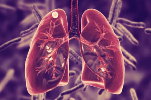 Mikä keuhkotuberkuloosi on ja mitkä sen oireet ovat?