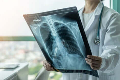 Piilevä keuhkotuberkuloosi havaitaan sattumalta tutkittaessa muita sairauksia