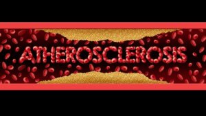 Valtimonkovettumataudin oireet ja hoito