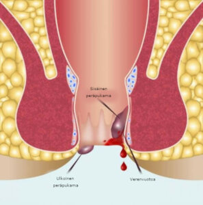 Peräsuolen tähystys – katsaus toimenpiteeseen