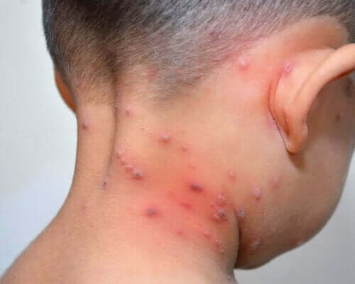 Herpes zoster lapsella.