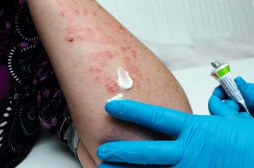 Herpes zosterin hoito.