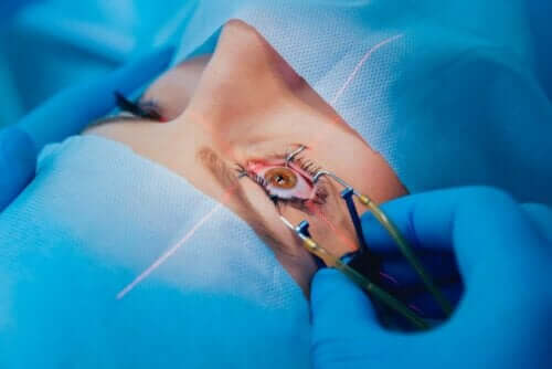 Kovakalvon identaatioleikkaus hoitaa verkkokalvoirtauman