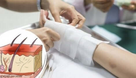 Toisen ja kolmannen asteen palovammat vaativat lääkärinhoitoa