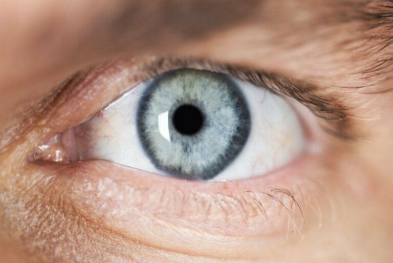 Mioosi eli pupillin supistustila - syyt ja tuntomerkit