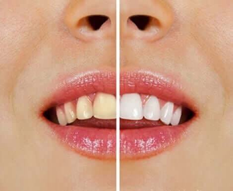 Luonnollisia tuotteita hampaiden valkaisuun