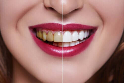 Mistä hampaiden värjäytyminen johtuu?