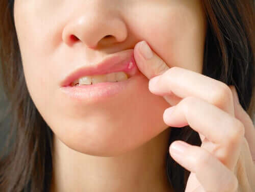 Suun limakalvon haavaumat: syyt ja hoito