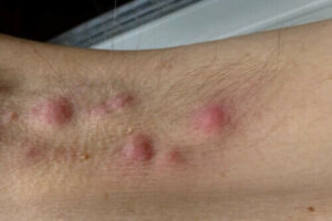 Hidradenitis suppurativa: onko ruokavaliosta apua?