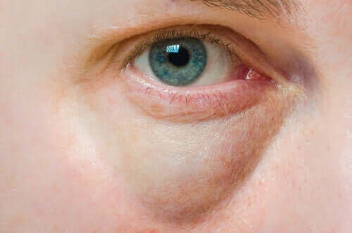 Turvonneet silmäluomet: syyt ja hoito