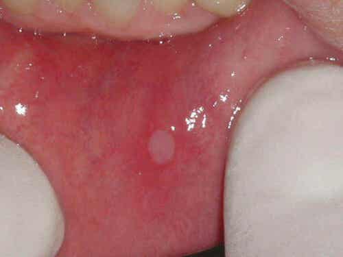 Suun limakalvon haavaumat ovat pieniä valkeita rakkuloita.