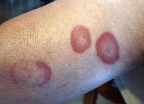 Rengasgranulooman oireet: punaiset täplät iholla.