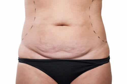 Abdominoplastia on vatsan ihon poisto.