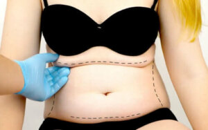 Mikä on abdominoplastia eli vatsan muodonkorjausleikkaus?
