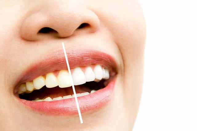 Hampaiden värjäytyminen johtuu useista eri tekijöistä