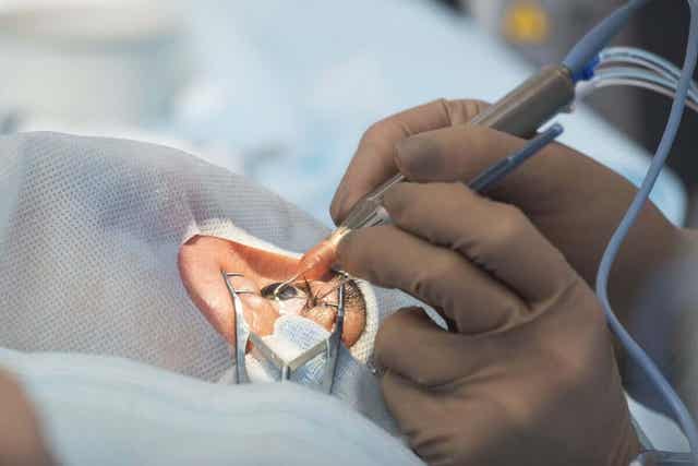 Silmänsisäinen linssileikkaus on nopea toimenpide.