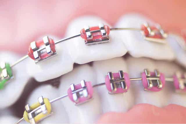 Oikomishoito lapsilla voidaan tehdä hammasraudoilla
