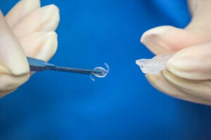 Silmänsisäinen linssileikkaus