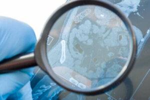 Mikä on ruoansulatuskanavan fisteli?