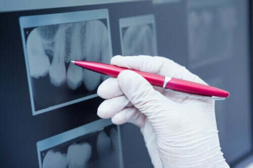Mikä on hampaiden kiillehypoplasia?