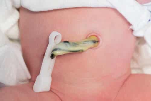Vastasyntyneen vauvan napaa tulee hoitaa oikealla tavalla infektioriskin pienentämiseksi.