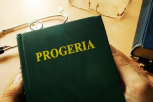 Mikä on Wernerin oireyhtymä