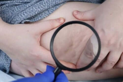 Maailman lipodystrofiapäivä - miksi sitä vietetään?
