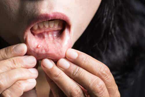Kaposin sarkooma esiintyy usein suussa.